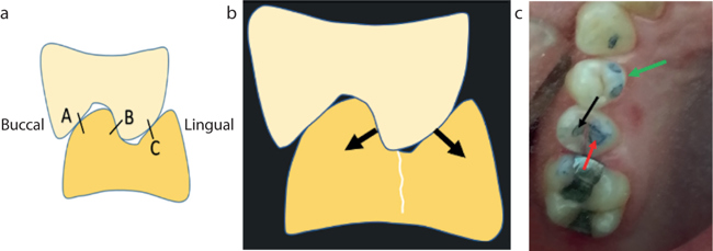 Figure 5 from Longitudinal tooth fractures: findings that
