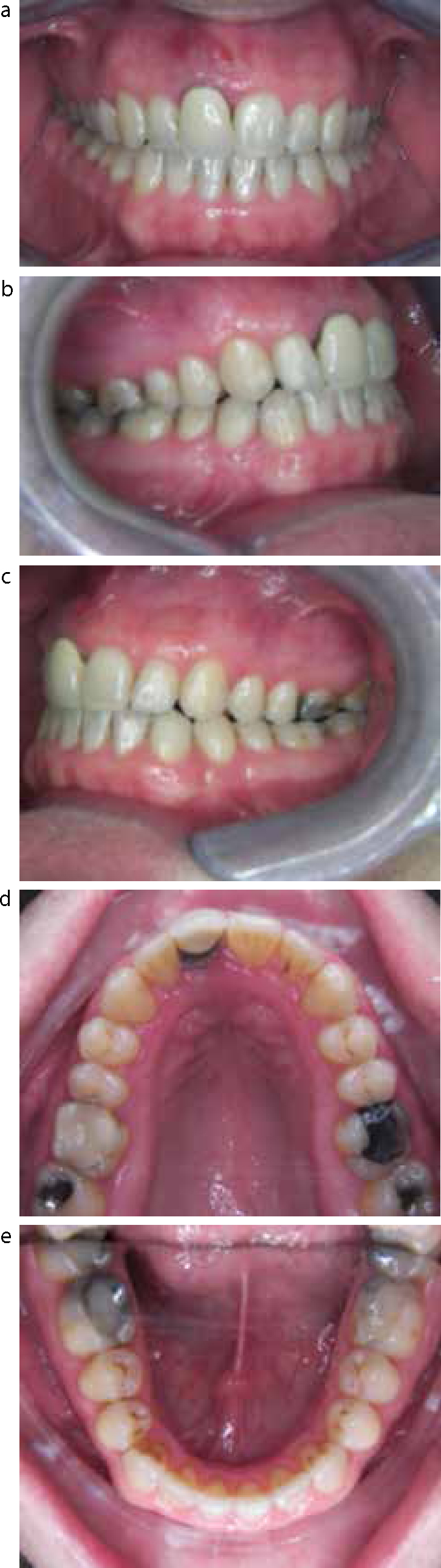 Dental Update - Invisible orthodontics part 1: invisalign