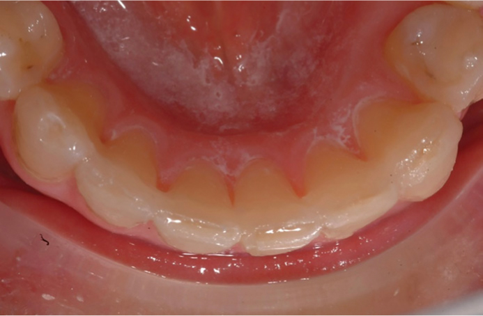 Wrap-around retainer in upper arch and spiral wire retainer in lower arch