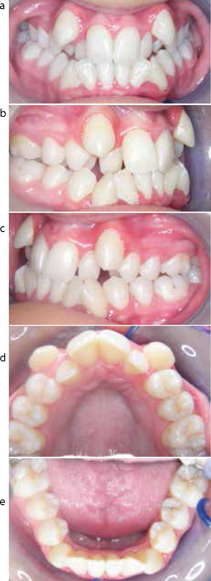 Dental Update - Invisible orthodontics part 2: lingual appliance treatment