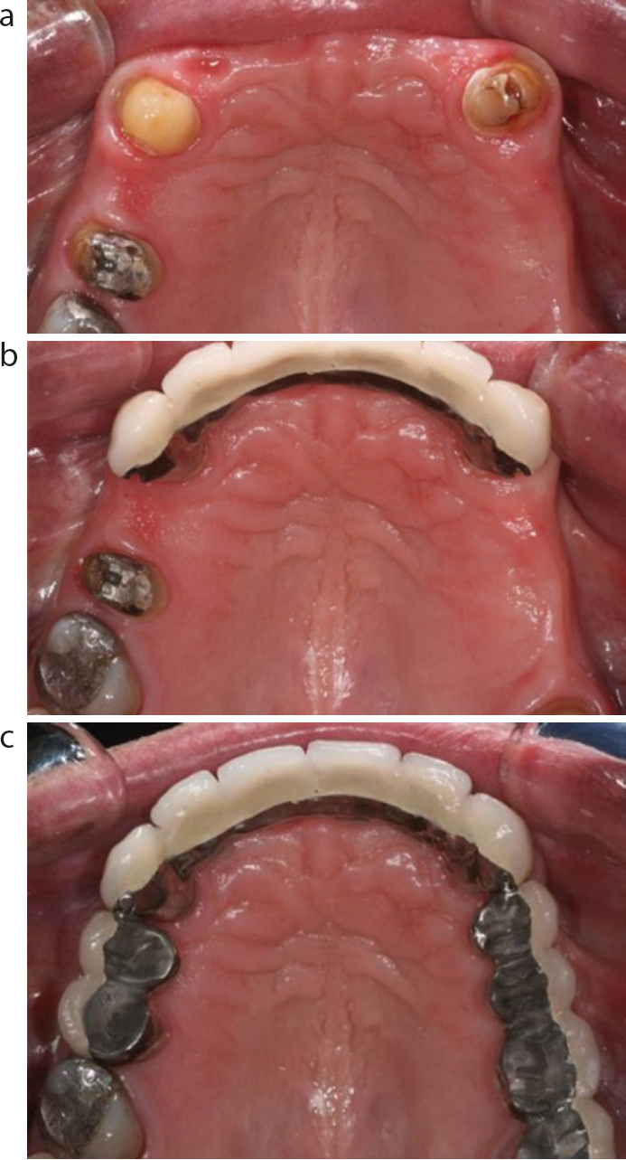 Treatment planning for the heavily compromised tooth by Stephen