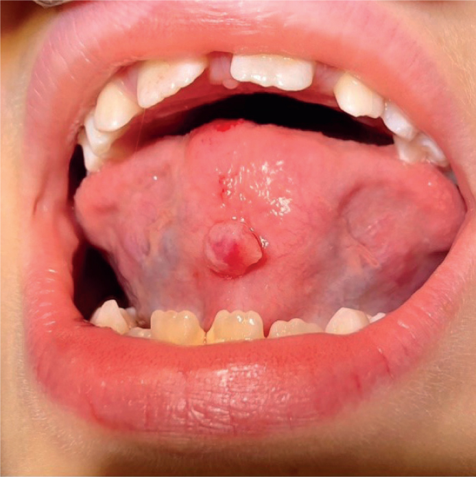 ventral buccal mucosa tongue