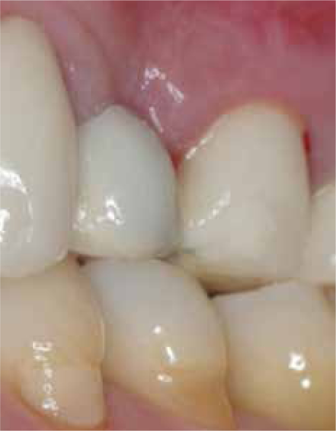 Dental Update - A new look at repairing fractured metal-ceramic  restorations: use of a universal bonding system and resin composite,  following sandblasting